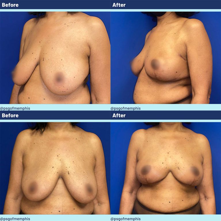 Breast Lift before and after - before