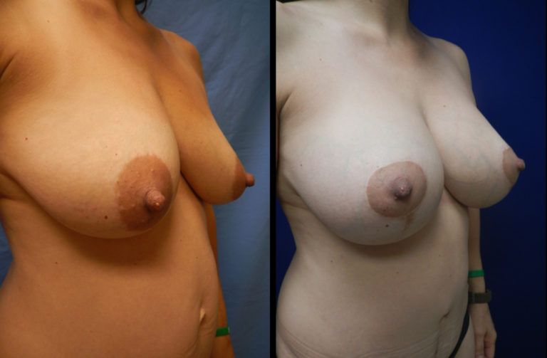 Mommy Makeover before and after - after