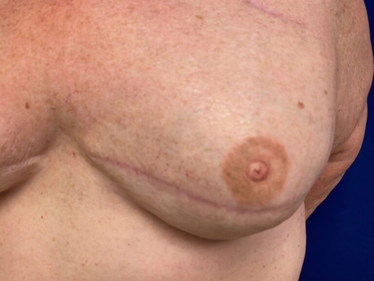 Nipple Tattooing before and after - after