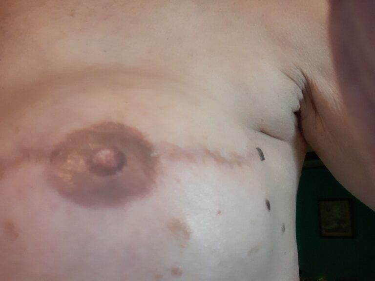 Nipple Tattooing before and after - before
