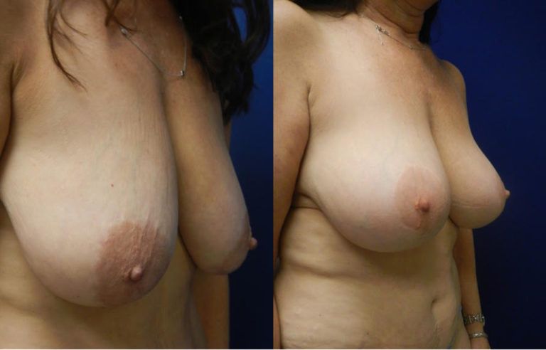 Mommy Makeover before and after - after