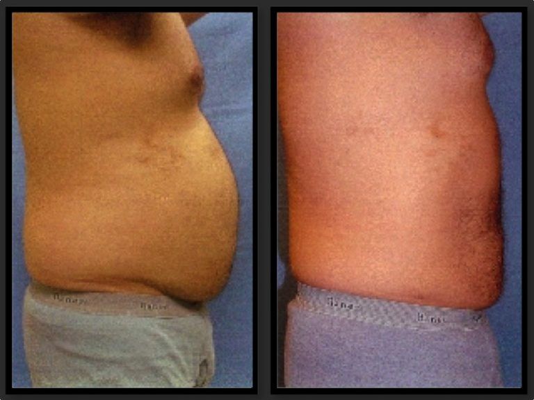 Liposuction before and after - after