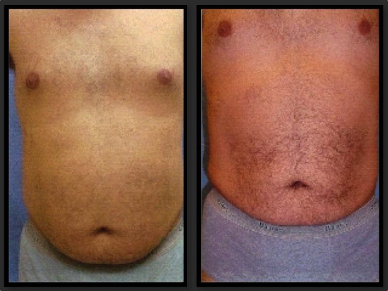 Liposuction before and after - before