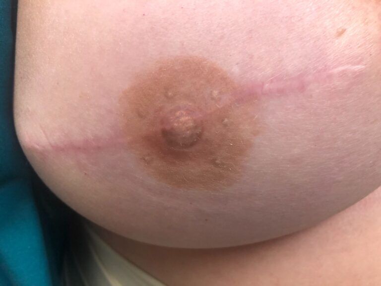 Nipple Tattooing before and after - after