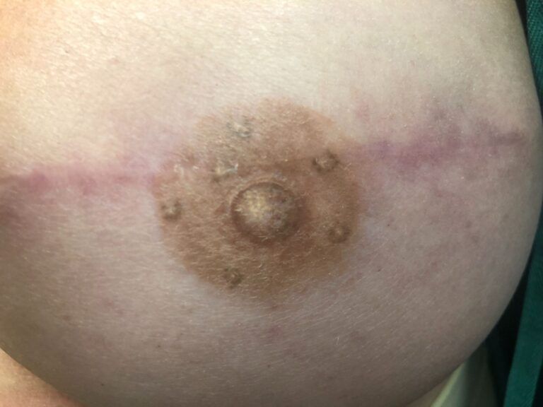 Nipple Tattooing before and after - before
