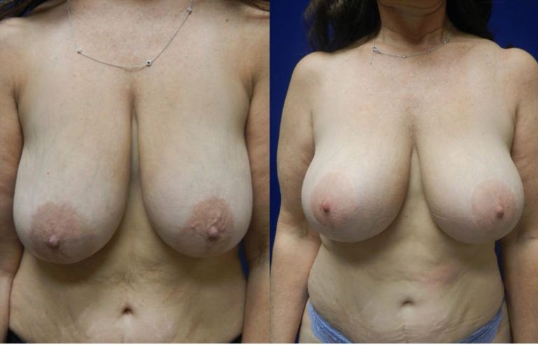 Mommy Makeover before and after - after