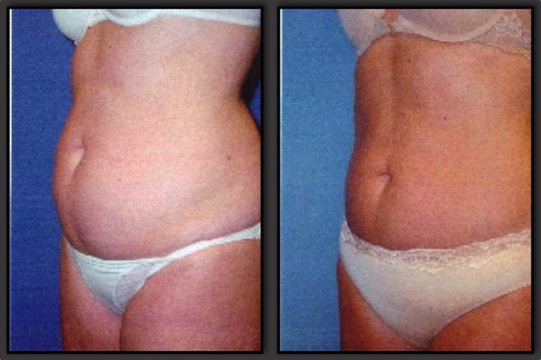 Liposuction before and after - after