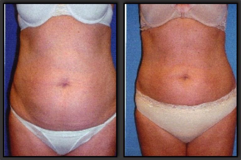 Liposuction before and after - before
