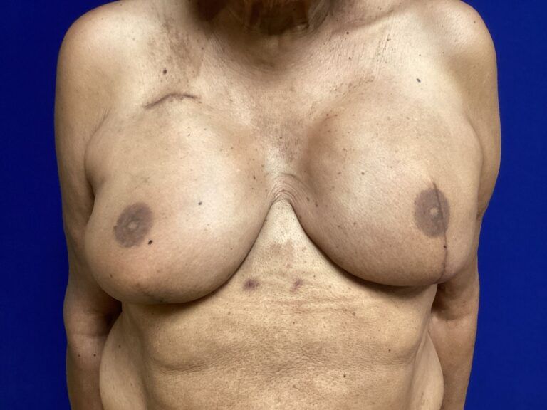 Nipple Tattooing before and after - after