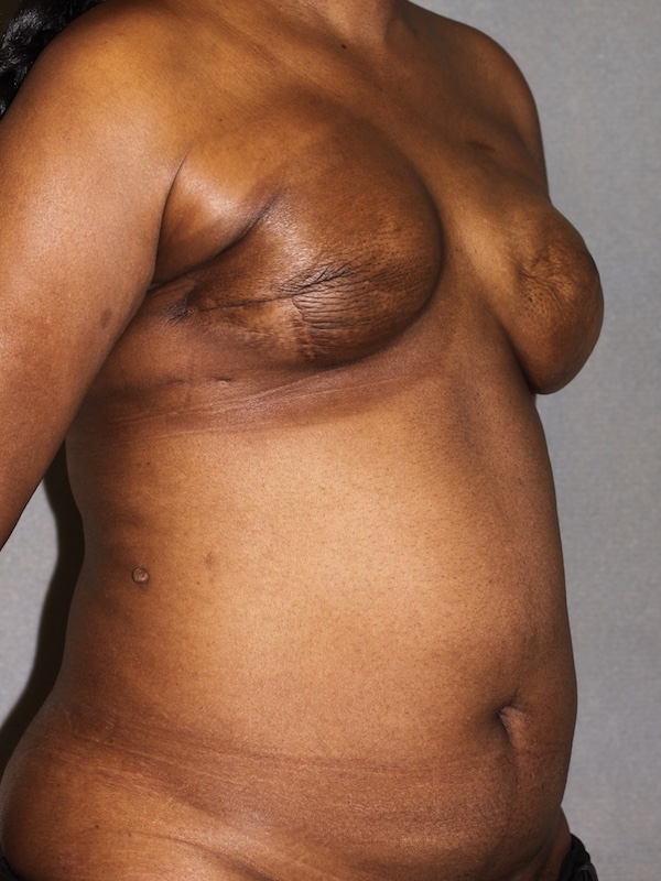 Breast Reconstruction Diep Flap before and after - before