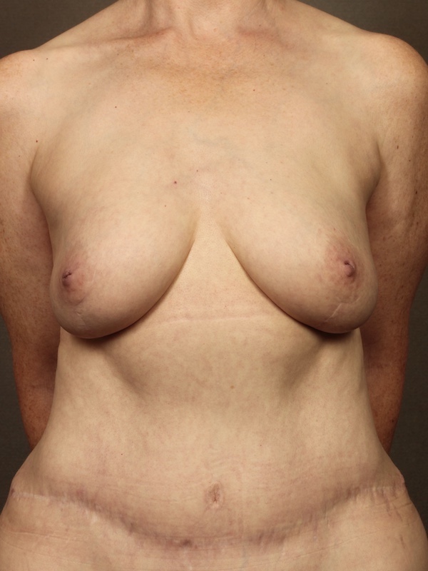 Breast Reconstruction Diep Flap: Nipple Sparing Mastectomy before and after - after