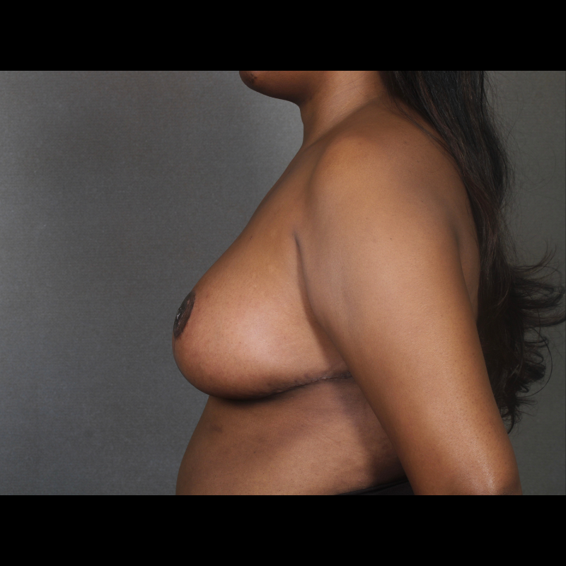 Breast Reduction before and after - after