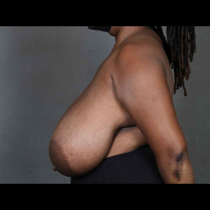 Breast Reduction before and after - before