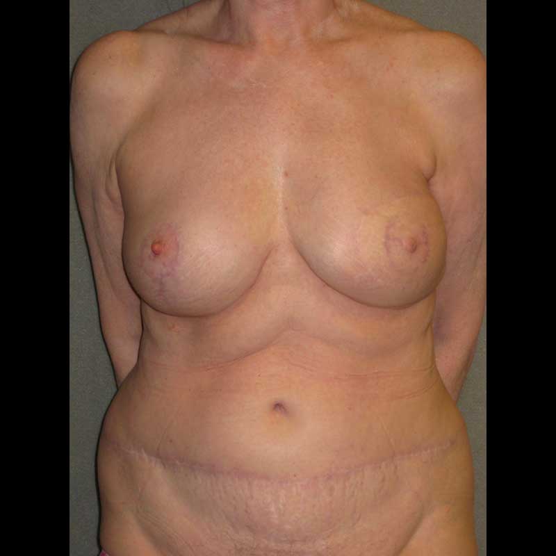 Breast Reconstruction Diep Flap before and after - after