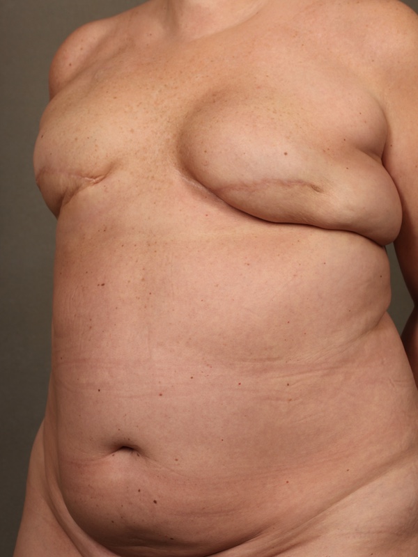 Breast Reconstruction Diep Flap before and after - before