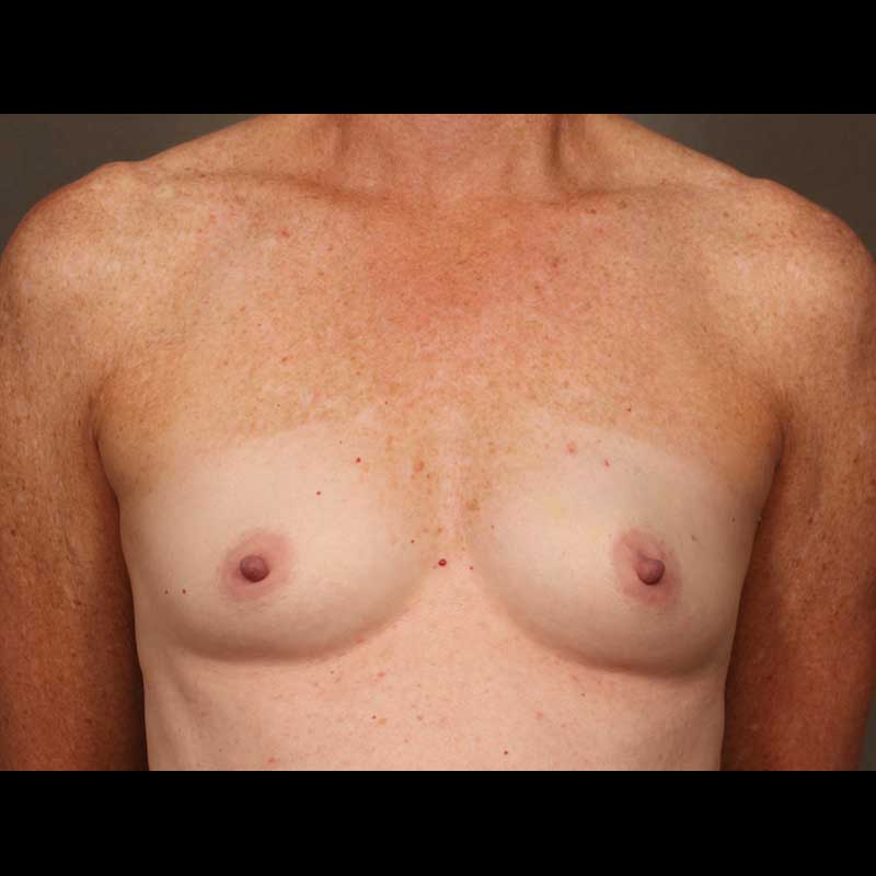 Breast Reconstruction Direct to Implant: Nipple Sparing Mastectomy before and after - before