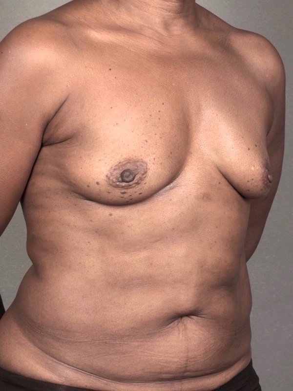 Breast Reconstruction Diep Flap: Nipple Sparing Mastectomy before and after - after