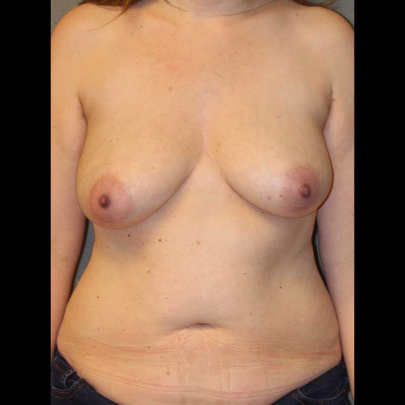Breast Reconstruction Diep Flap: Skin Sparing Mastectomy before and after - before
