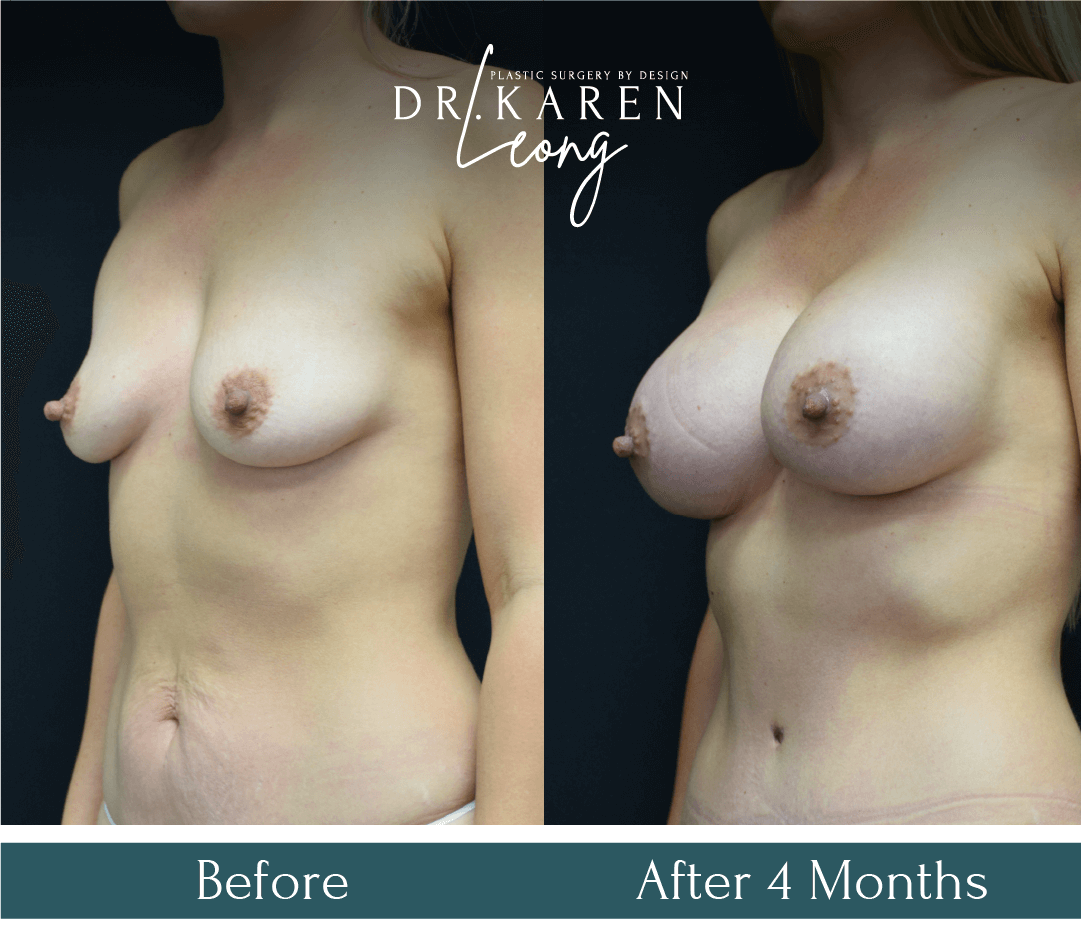Breast Augmentation before and after - before