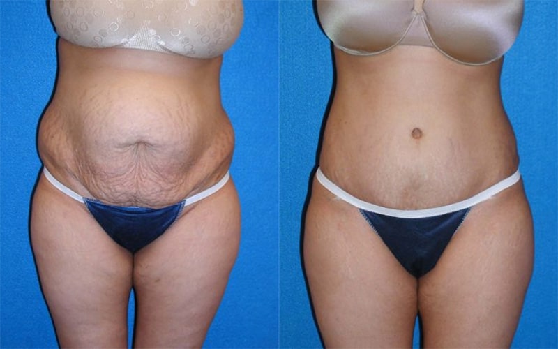 Tummy Tuck before and after - after