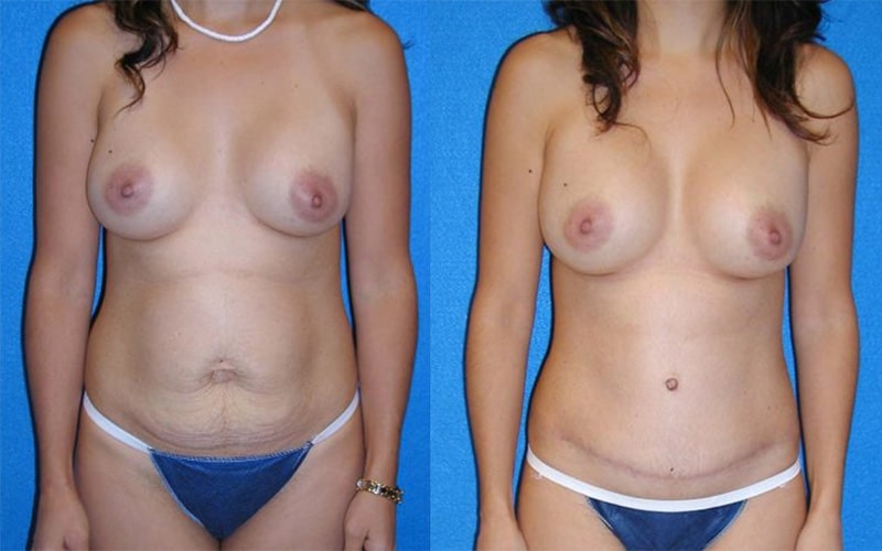 Tummy Tuck before and after - before