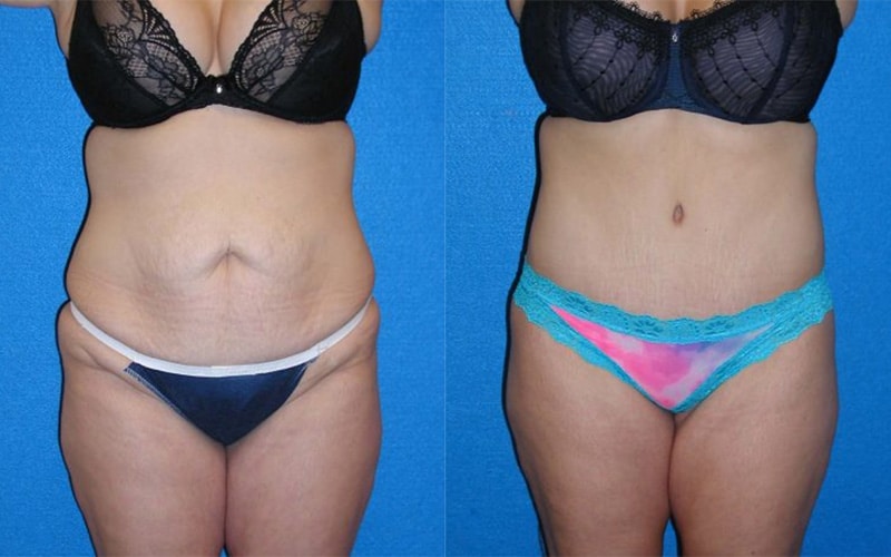Tummy Tuck before and after - after