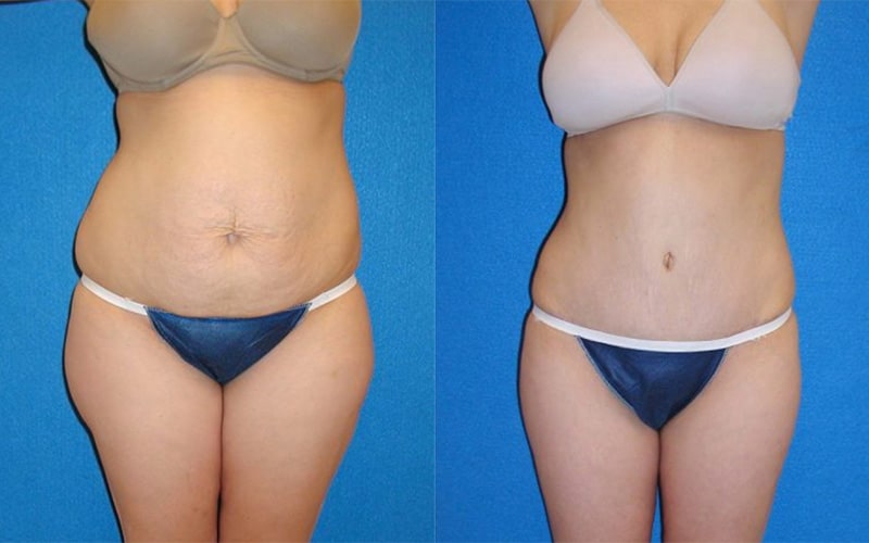 Tummy Tuck before and after - before