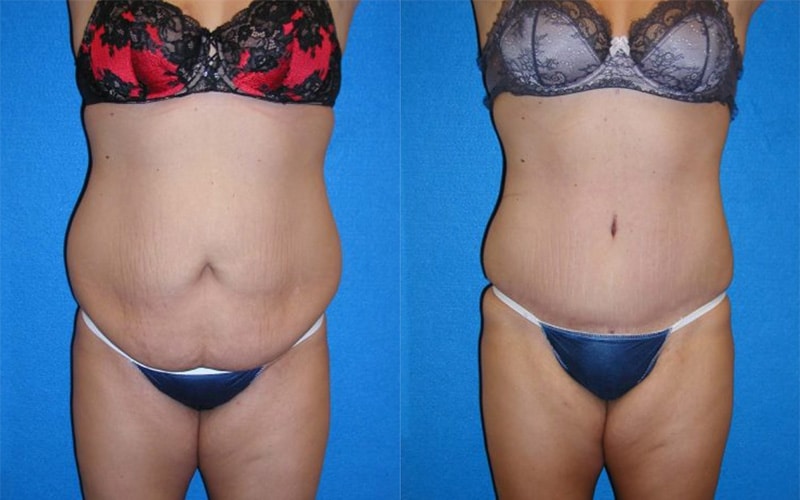 Tummy Tuck before and after - before