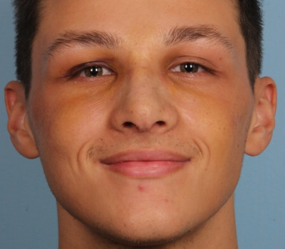 Rhinoplasty before and after - after