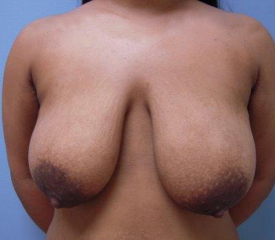 Breast Lift before and after - before