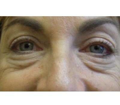 Blepharoplasty before and after - before