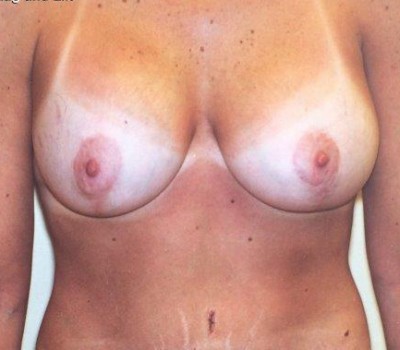Procedure before and after - after