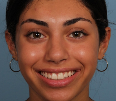 Rhinoplasty before and after - after