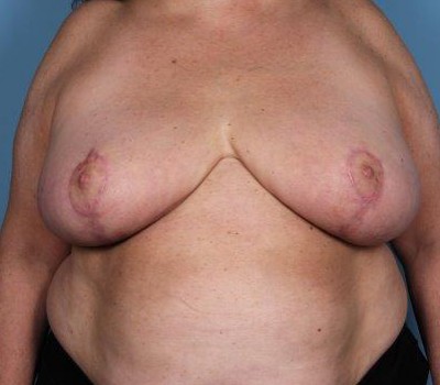 Breast Lift before and after - after