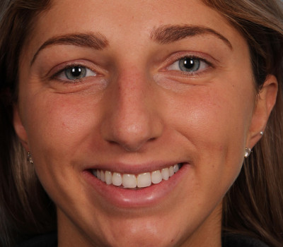 Rhinoplasty before and after - before
