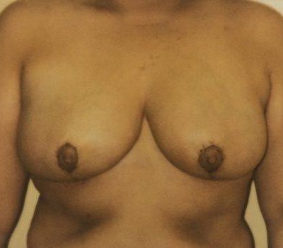 Breast Lift before and after - after