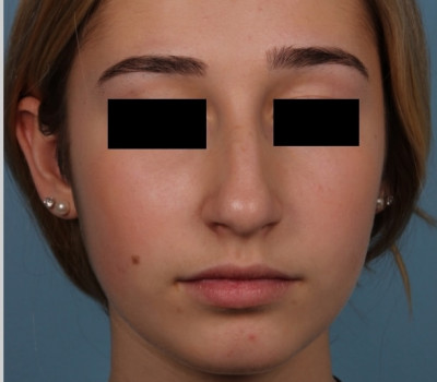 Rhinoplasty before and after - before