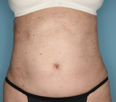 Liposuction before and after - after
