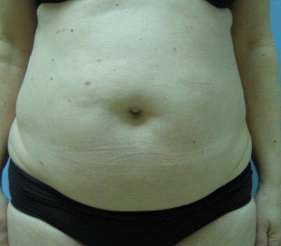 Liposuction before and after - before