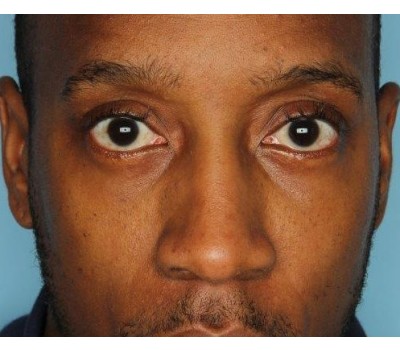 Blepharoplasty before and after - after
