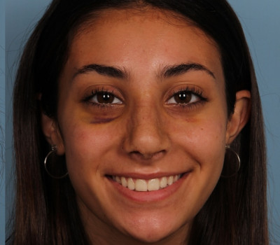 Rhinoplasty before and after - after