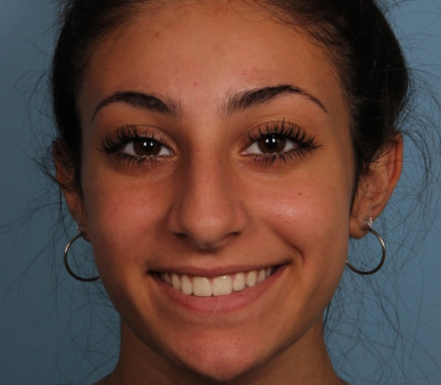 Rhinoplasty before and after - before