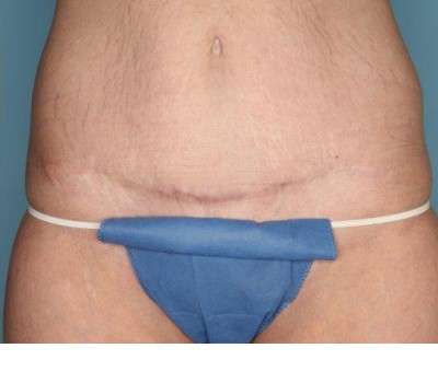 Liposuction before and after - after