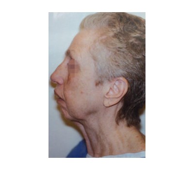 Liposuction before and after - before