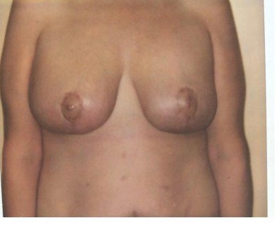 Procedure before and after - after
