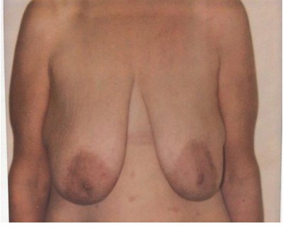 Breast Augmentation before and after - before