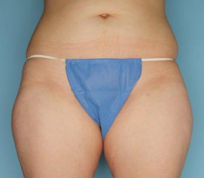 Liposuction before and after - before