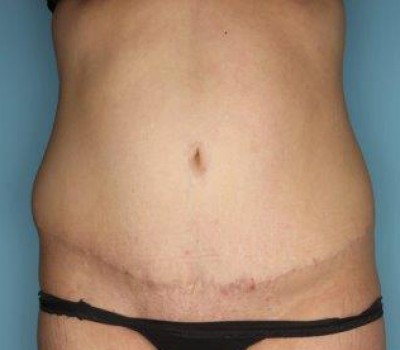 Liposuction before and after - after