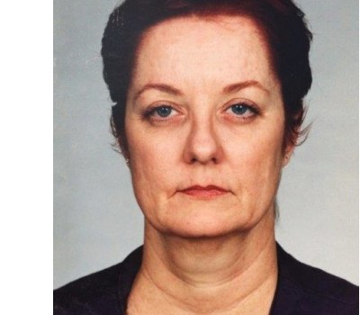 Blepharoplasty before and after - before
