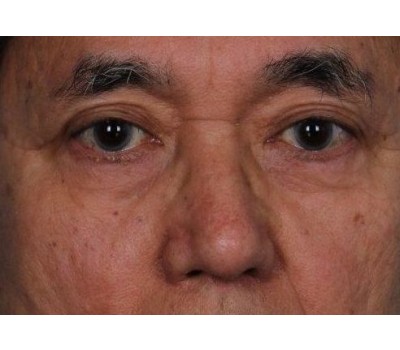 Blepharoplasty before and after - after